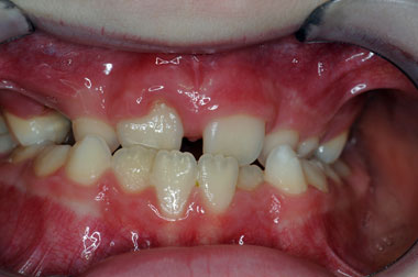 Interceptive-Orthodontics-ODonnell-Orthodontics