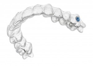 Invisalign Teenager