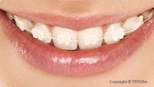 ceramic-braces