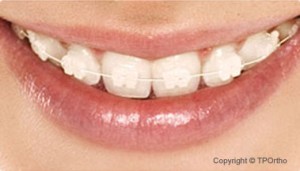 ceramic-braces